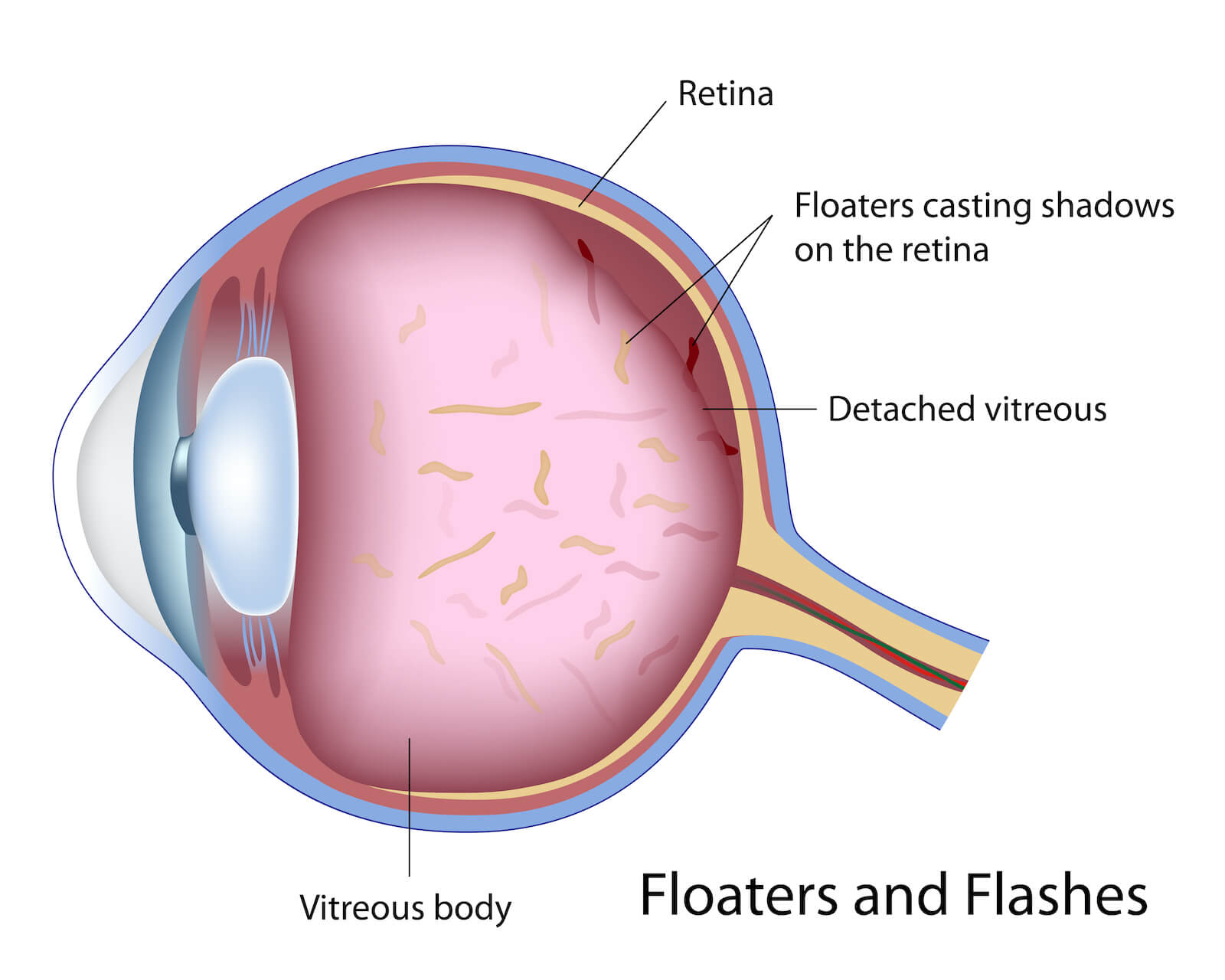 Flashes Floaters San Jose Retina Conditions Santa Clara Spectrum