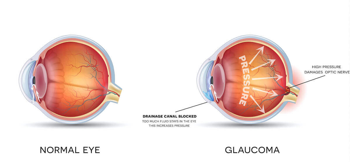 Glaucoma San Jose Glaucoma Treatment Santa Clara Spectrum Eye