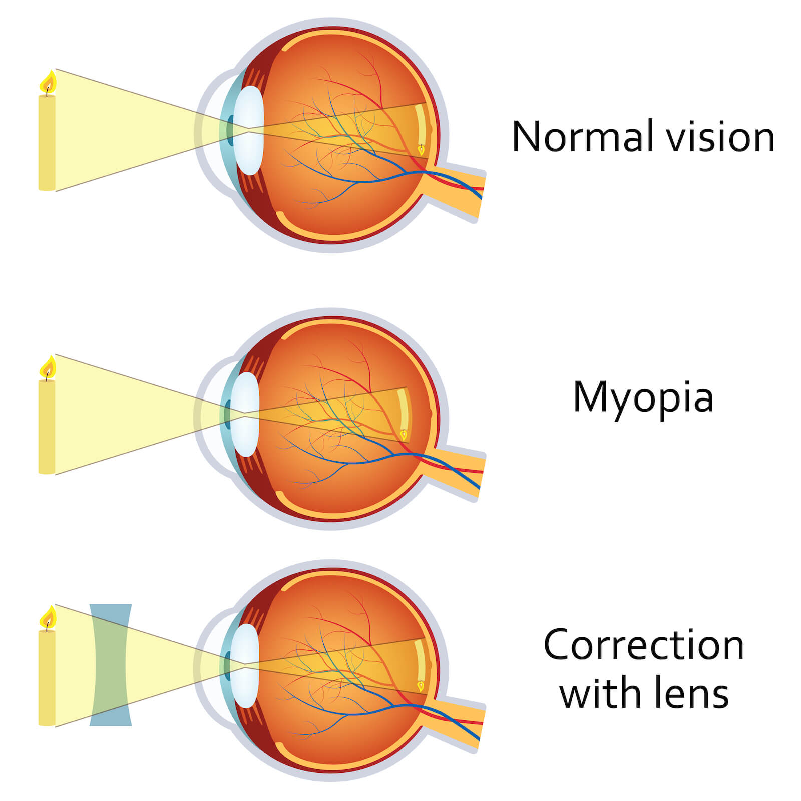 Nearsightedness San Jose Eye Doctor Santa Clara Spectrum Eye